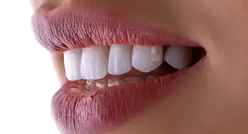 A natural smile