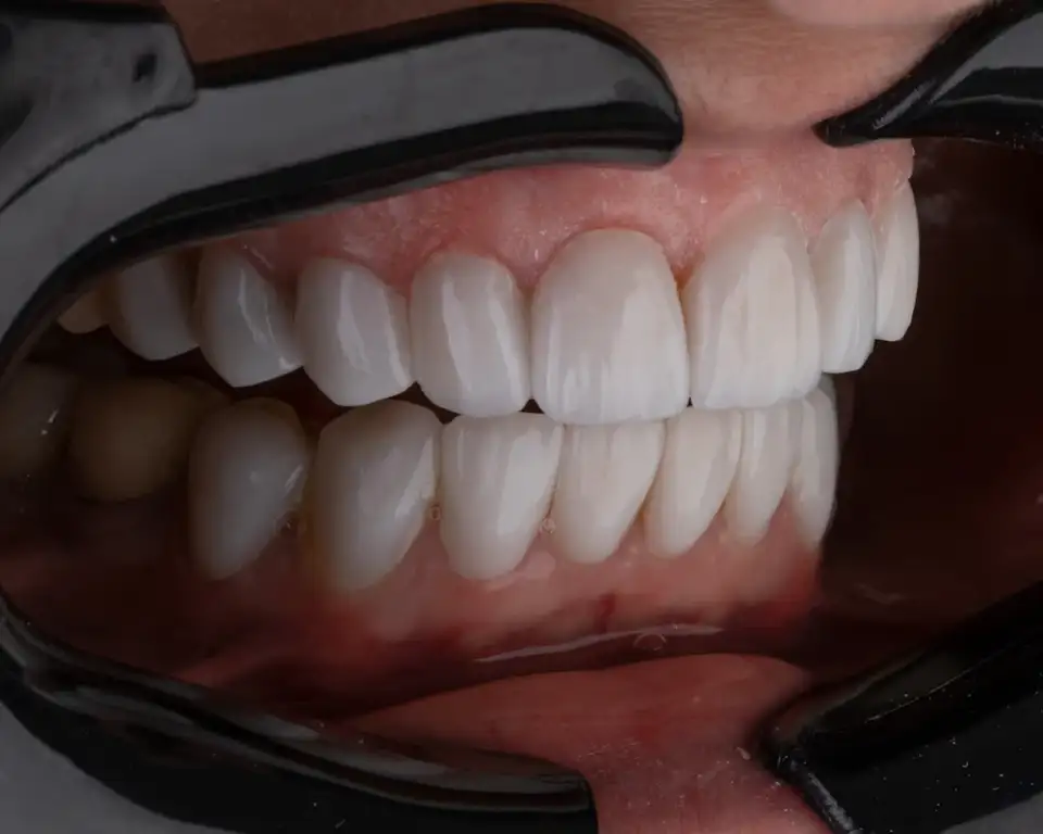Veneers and E-max veneers