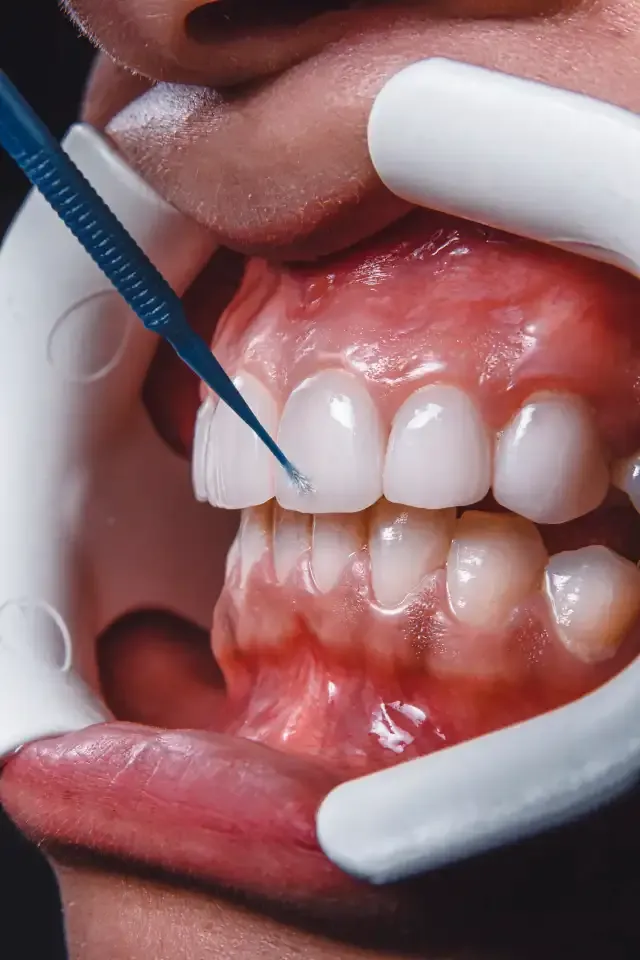 Zirconia crowns